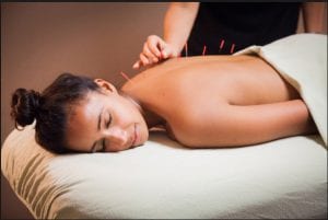 therapist using acupuncture needles for treatment